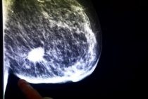 Studiu: Hiperplazia atipică ar putea crește riscul de cancer mamar