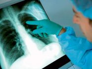 Standarde actualizate pentru tratamentul tuberculozei