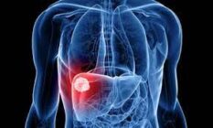 Cazurile de cancer hepatic vor crește cu 55% în următoarele decenii