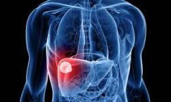 Cazurile de cancer hepatic vor crește cu 55% în următoarele decenii